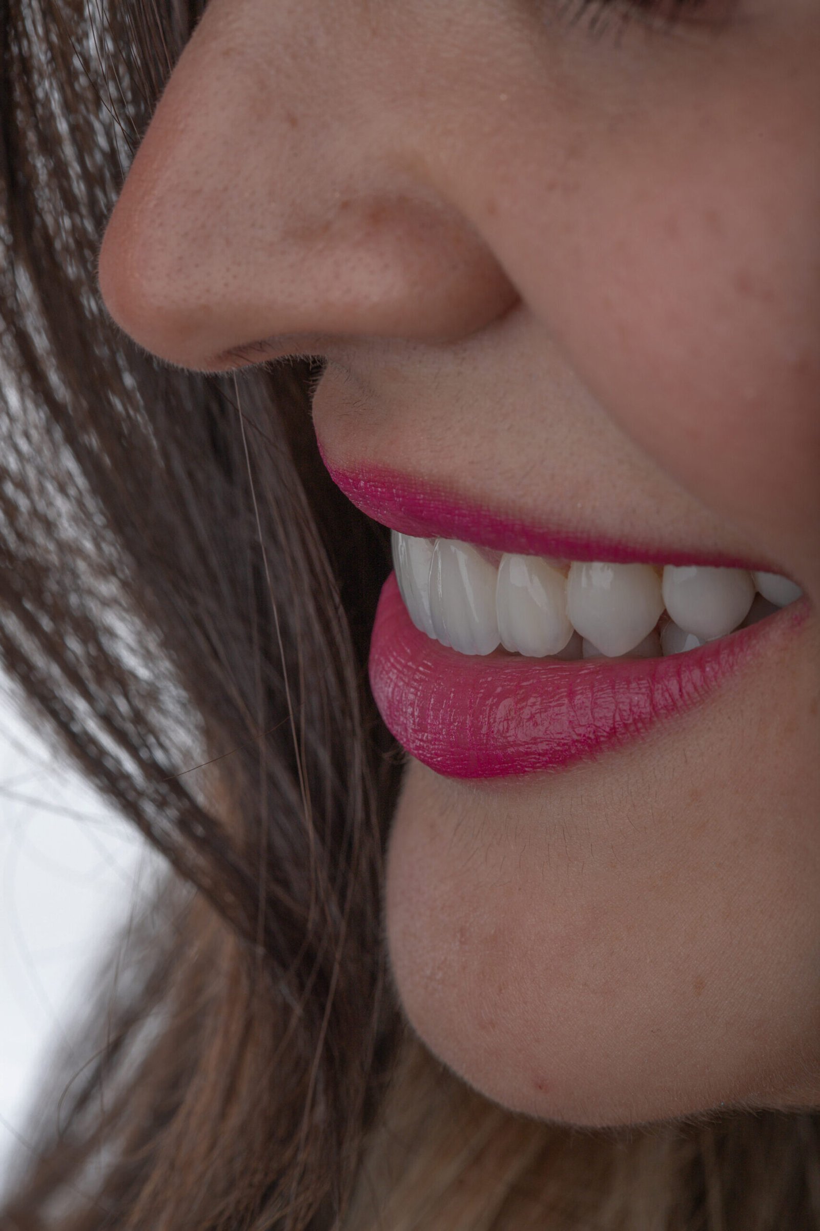 Estratificación manual con Ivoclar E.max Ceram Selection para recrear la anatomía dental perdida por trauma oclusal.