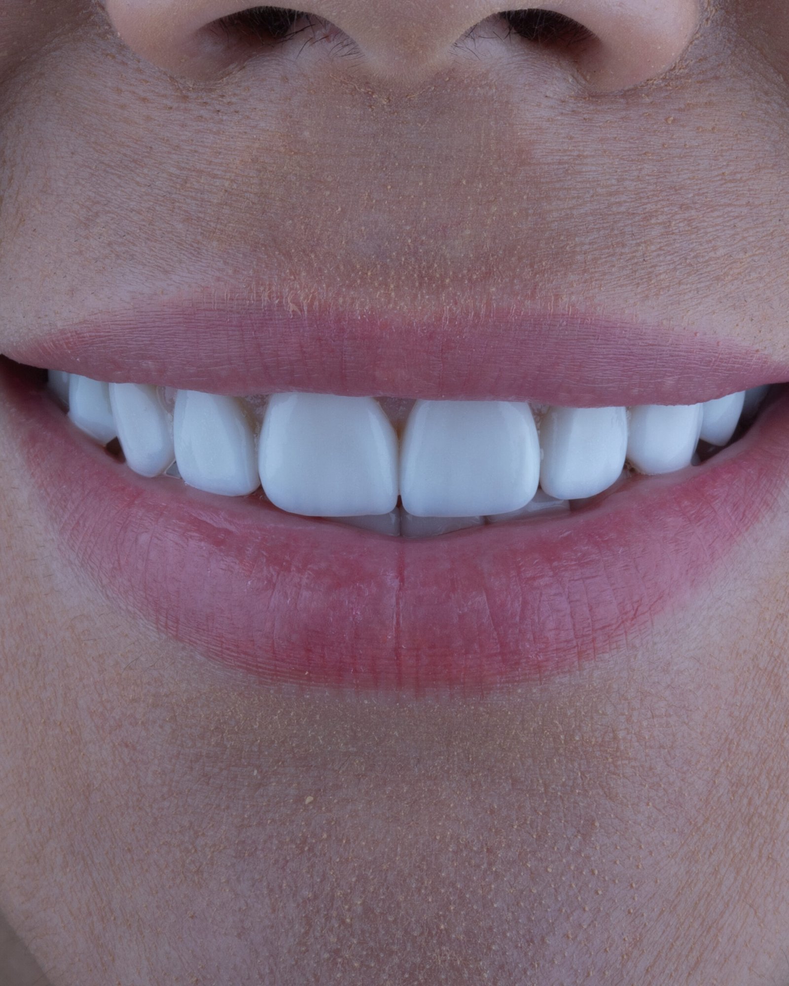 Renovación de carillas de cerámica de baja estética por un diseño de alta gama y naturalidad, corrigiendo color y forma con la técnica de la Dra. Lina Bedoya.