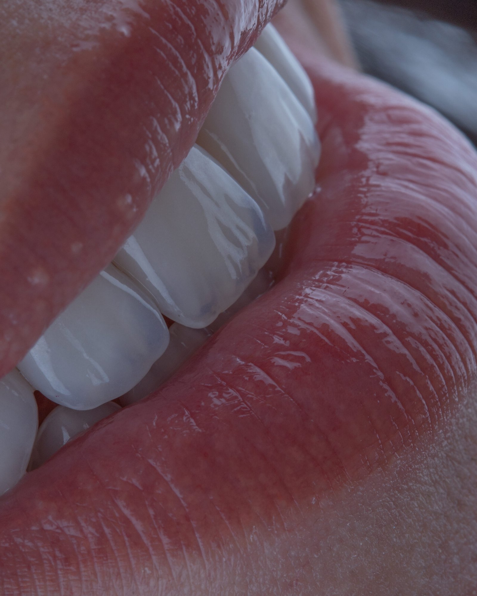 Armonía entre el diseño de sonrisa y la estética facial, logrando un equilibrio perfecto que realza las facciones naturales de la paciente, por la Dra. Lina Bedoya