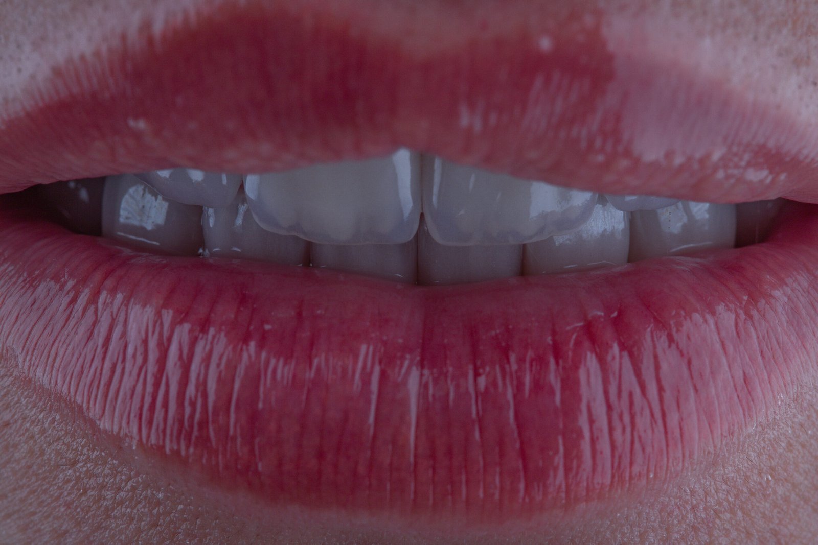 Efecto natural y delicado en diseño de sonrisa con carillas de cerámica, resaltando la suavidad y el brillo auténtico de una sonrisa creada por la Dra. Lina Bedoya.