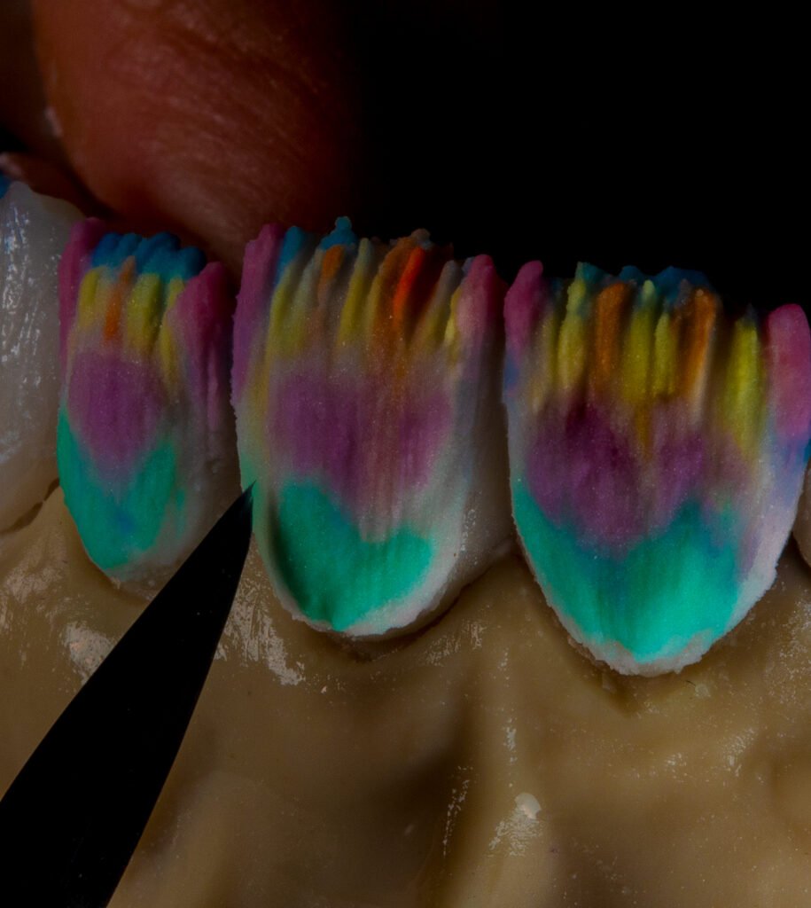 Maestría artesanal en la estratificación de disilicato de litio, donde la Dra. Lina Bedoya esculpe capas de luz y color para lograr una mimetización perfecta con la naturaleza dental.