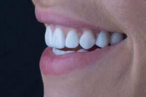 Evidencia clínica de carillas con morfología artificial y falta de detalles anatómicos, antes de ser transformadas por la Dra. Lina Bedoya hacia un resultado natural.