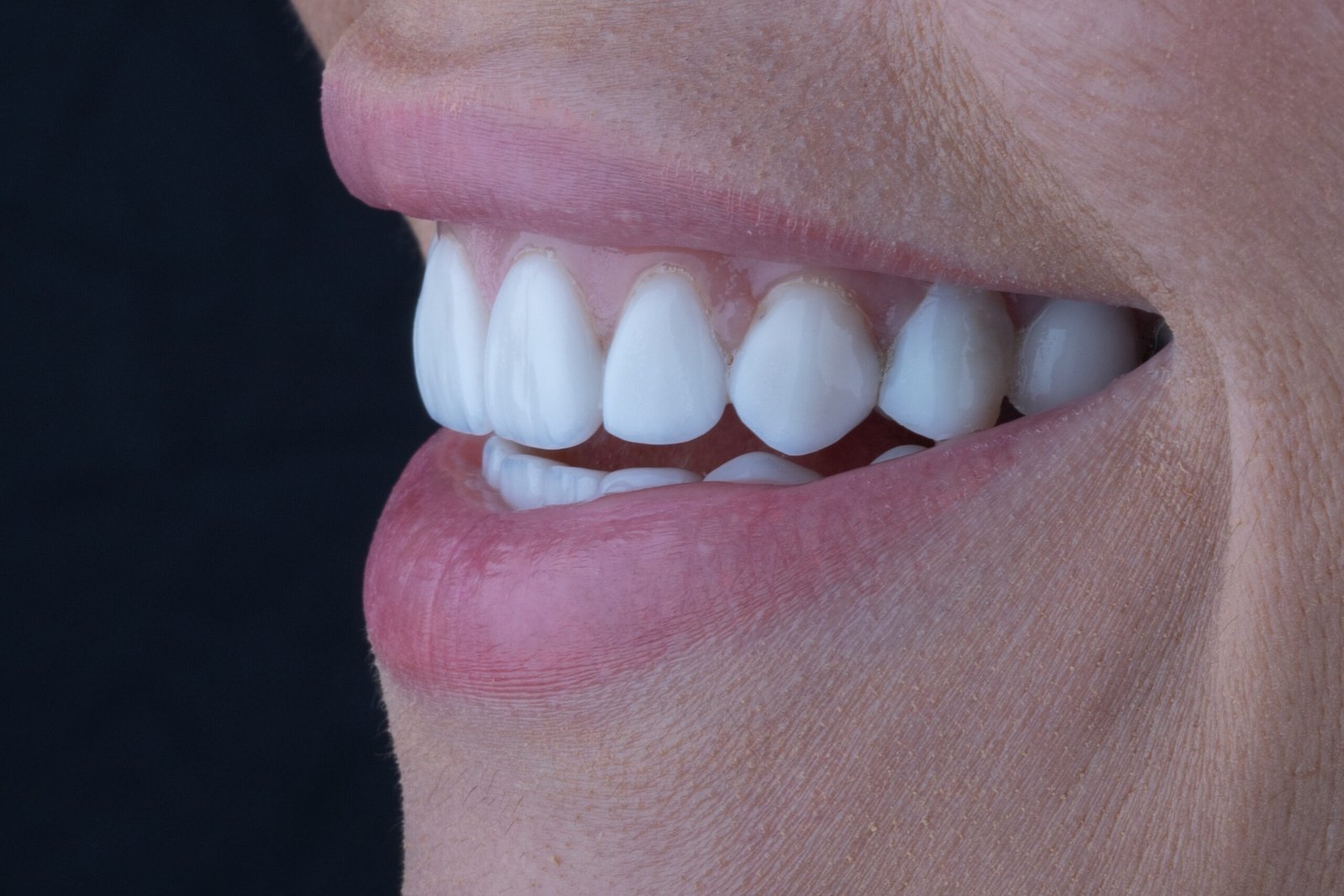 Evidencia clínica de carillas con morfología artificial y falta de detalles anatómicos, antes de ser transformadas por la Dra. Lina Bedoya hacia un resultado natural.