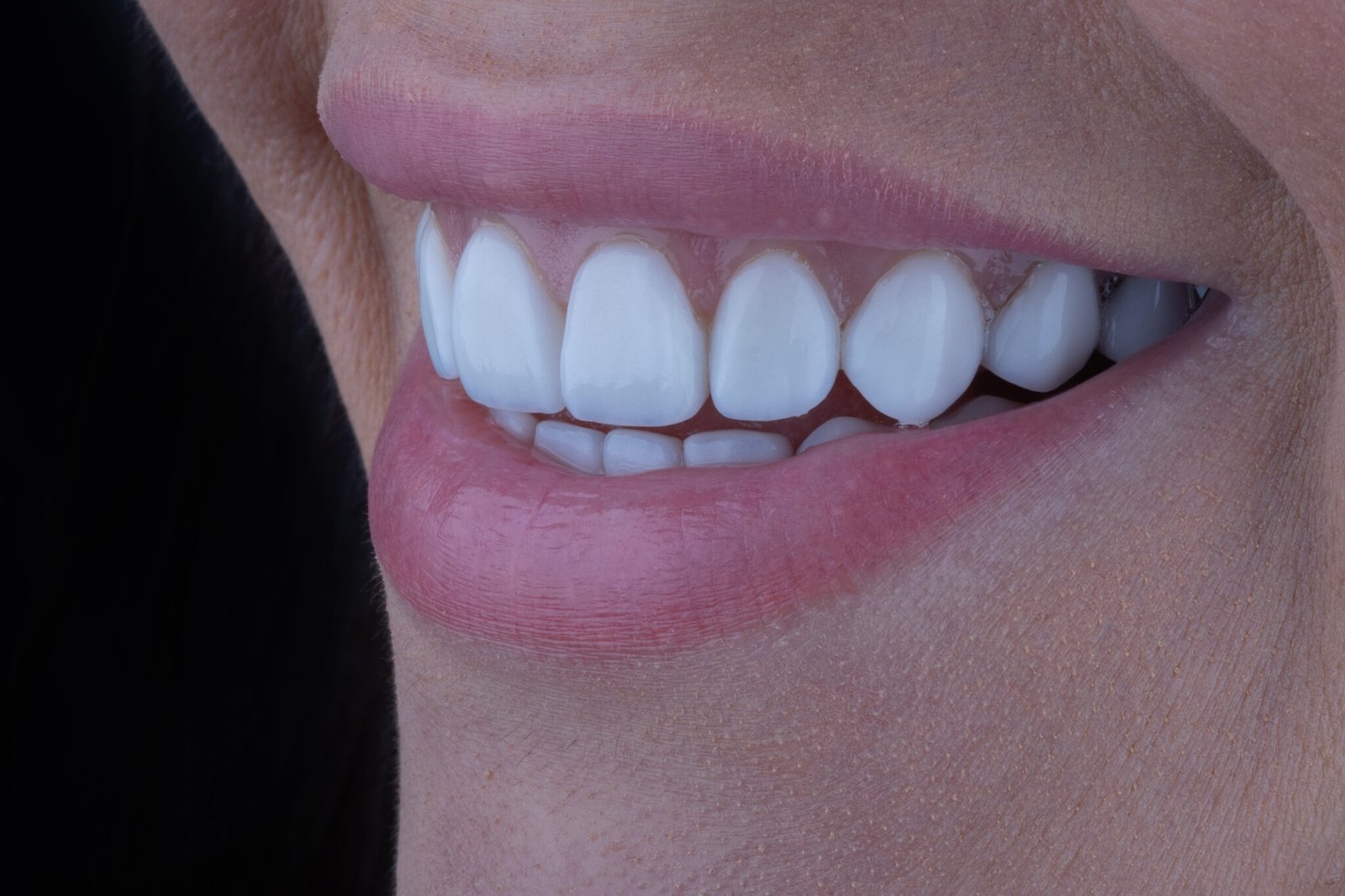 Sonrisa con carillas antiguas que presentan falta de translucidez y ausencia de caracterización natural, antes de la renovación estética por la Dra. Lina Bedoya.