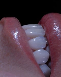 Detalle de micro-relieve y anatomía dental avanzada en carillas de porcelana, logrando una reflexión de luz natural, por la Dra. Lina Bedoya.