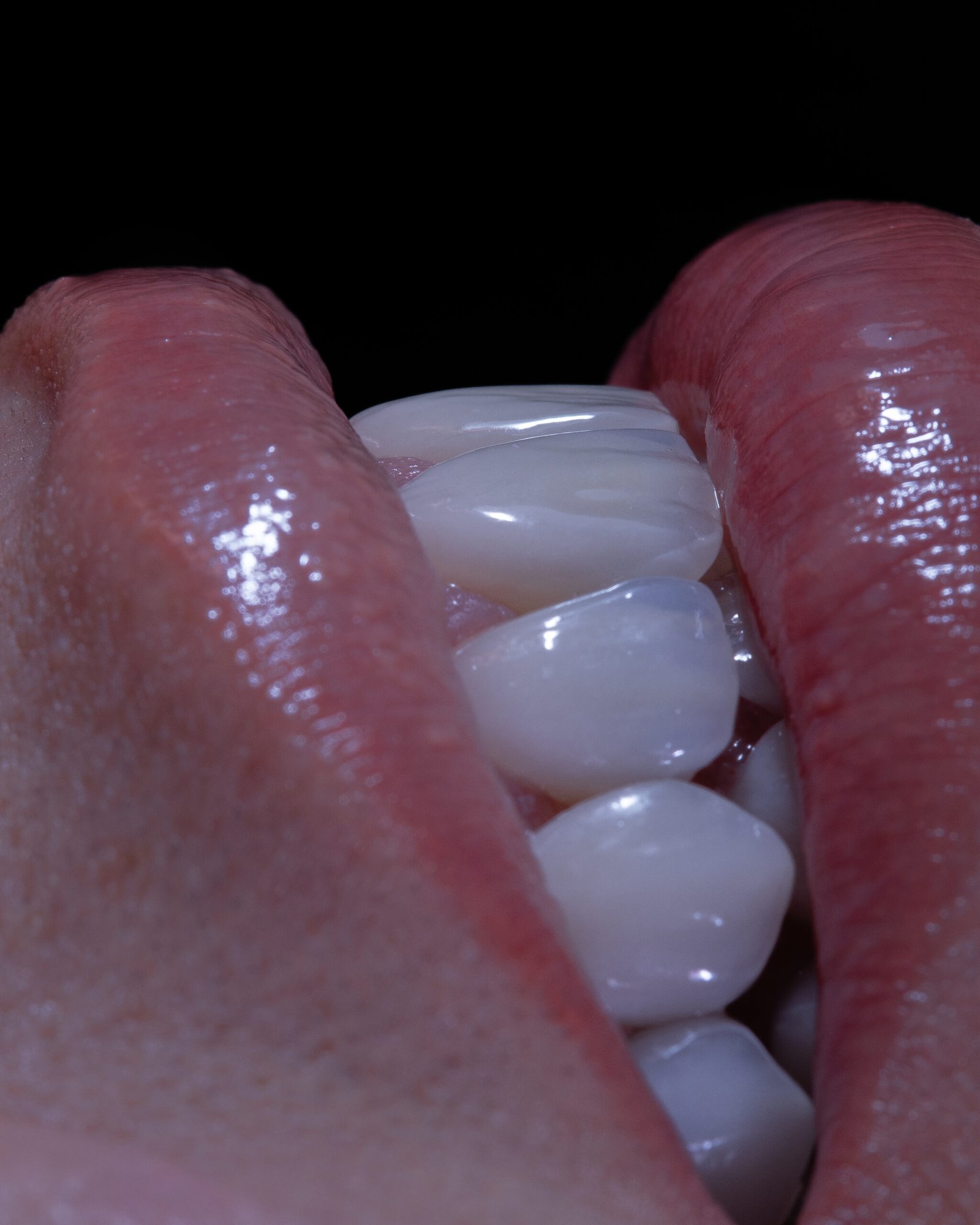 Detalle de micro-relieve y anatomía dental avanzada en carillas de porcelana, logrando una reflexión de luz natural, por la Dra. Lina Bedoya.