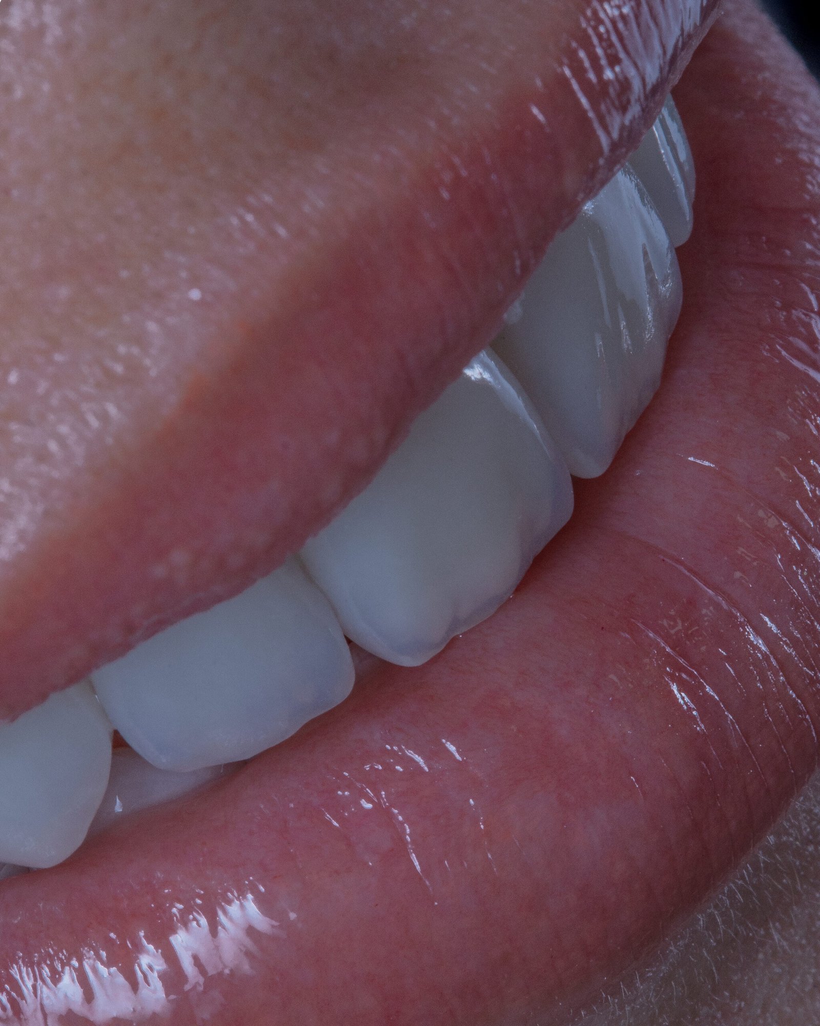 Mimetismo dental absoluto logrado con carillas en disilicato de litio, donde la restauración se integra invisiblemente con la estructura natural, por la Dra. Lina Bedoya.