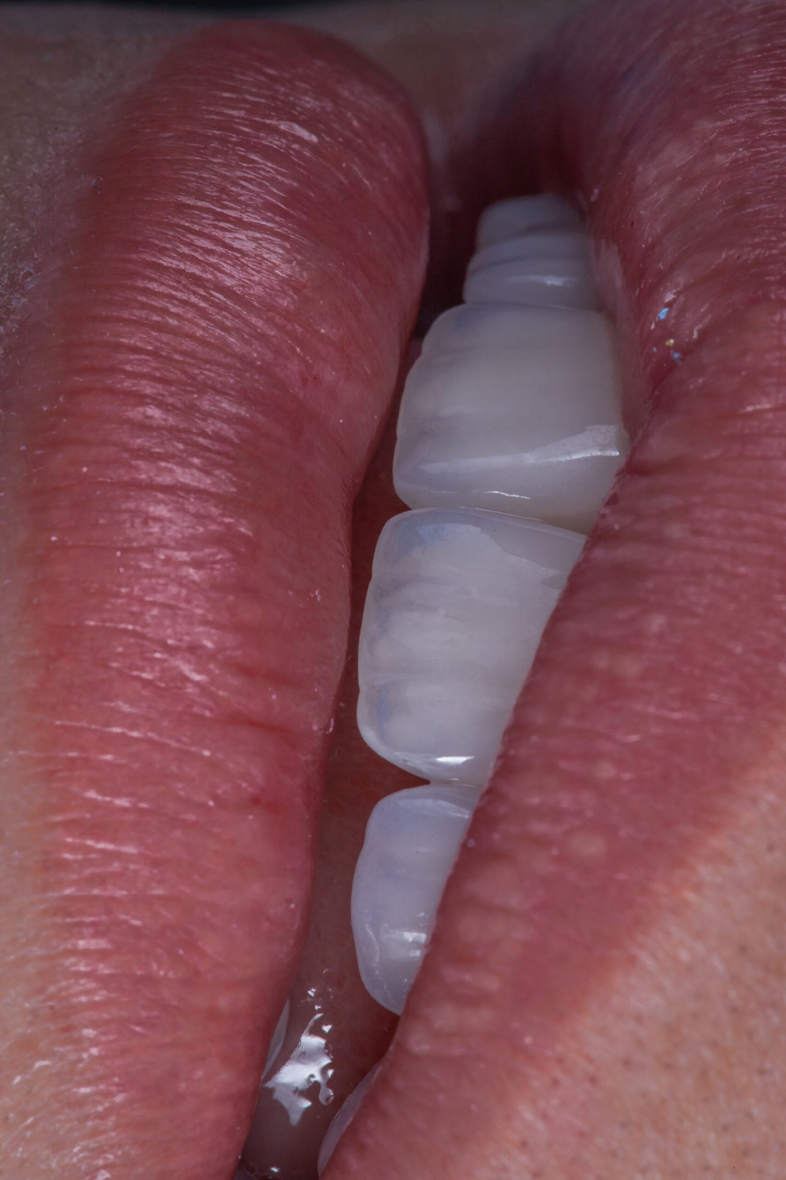 Detalle macro de la textura y micro-morfología natural en carillas de cerámica estratificada realizadas por la Dra. Lina Bedoya.