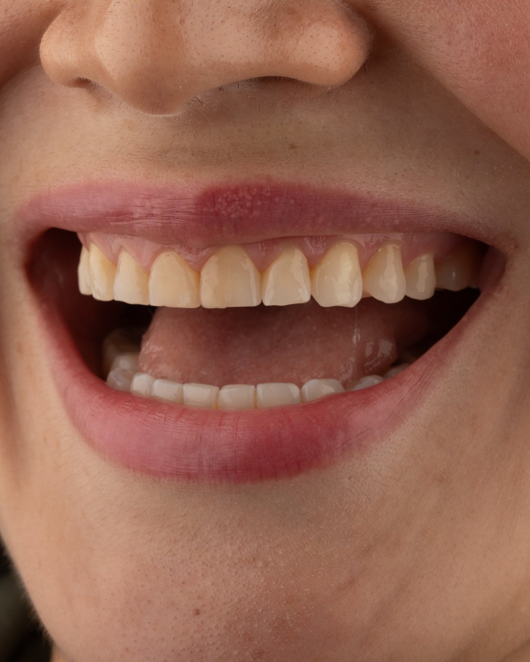 Análisis clínico inicial de armonía dental y morfología previo a rehabilitación con disilicato de litio