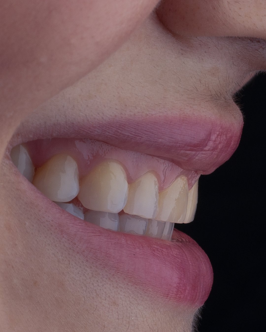 Análisis de la morfología y tono dental inicial antes de la restauración con disilicato de litio.