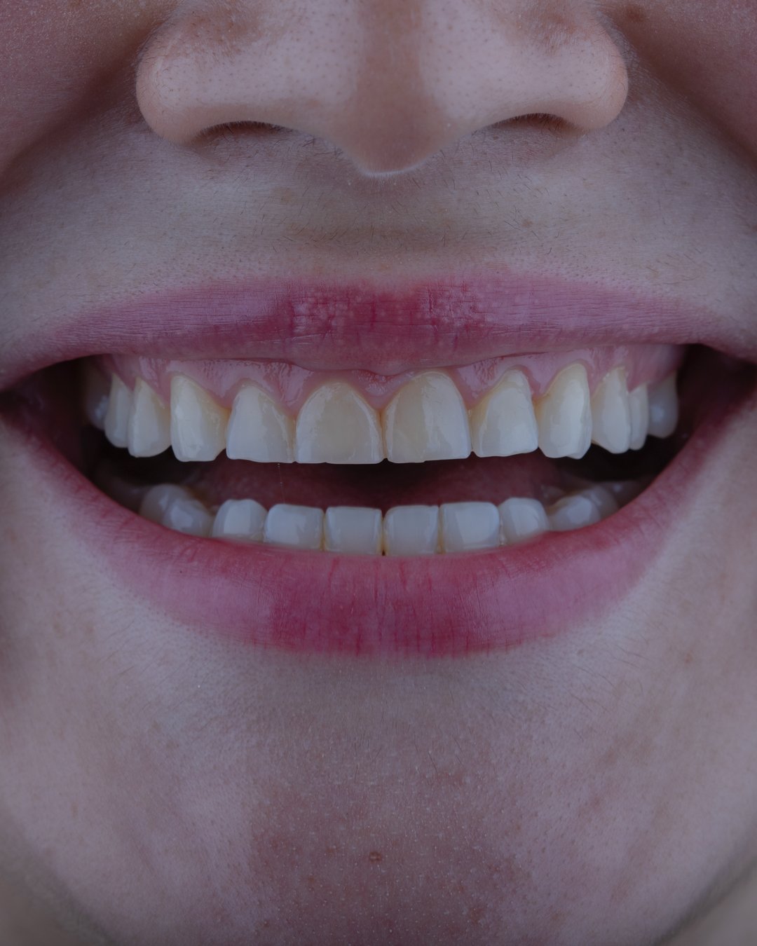 Antes y después de diseño de sonrisa artesanal comparando la evolución estética y funcional.