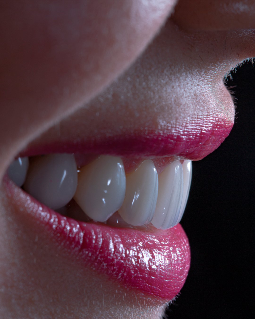 Armonía final de la sonrisa integrada con el rostro mediante rehabilitación oral de alta gama.