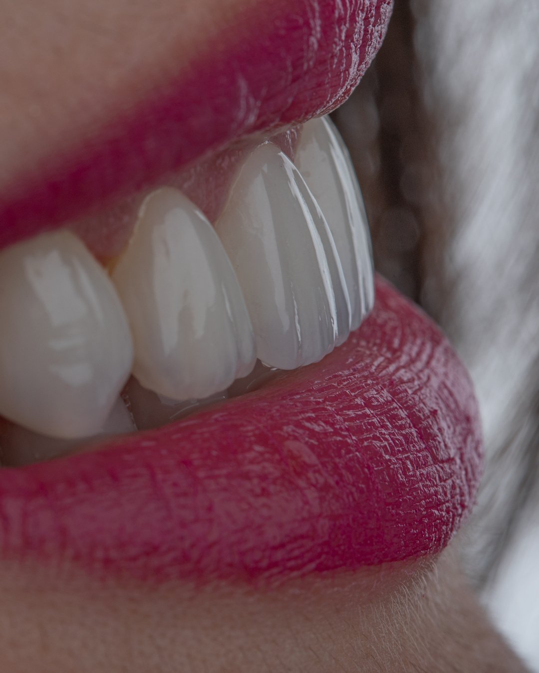 Efecto de fluorescencia y brillo natural en cerámica Ivoclar E.max Ceram Selection.