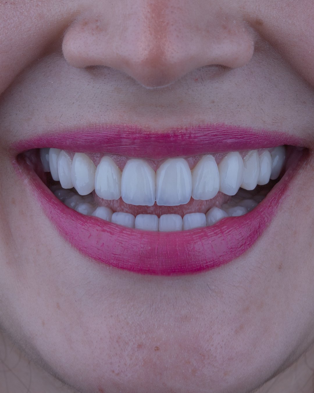 Transición cromática hacia un blanco natural y saludable con tecnología de disilicato de litio.