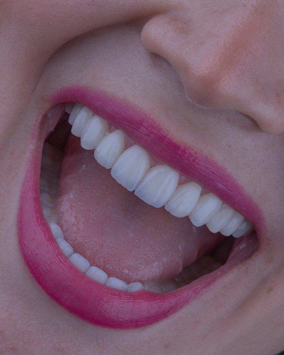 Proceso de estratificación manual con E.max Ceram Selection para máxima mimetización dental.