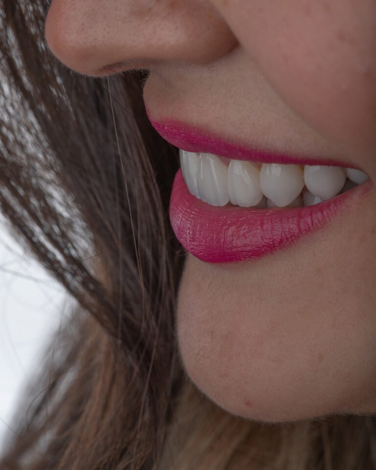 Estratificación manual con Ivoclar E.max Ceram Selection para recrear la anatomía dental perdida por trauma oclusal.