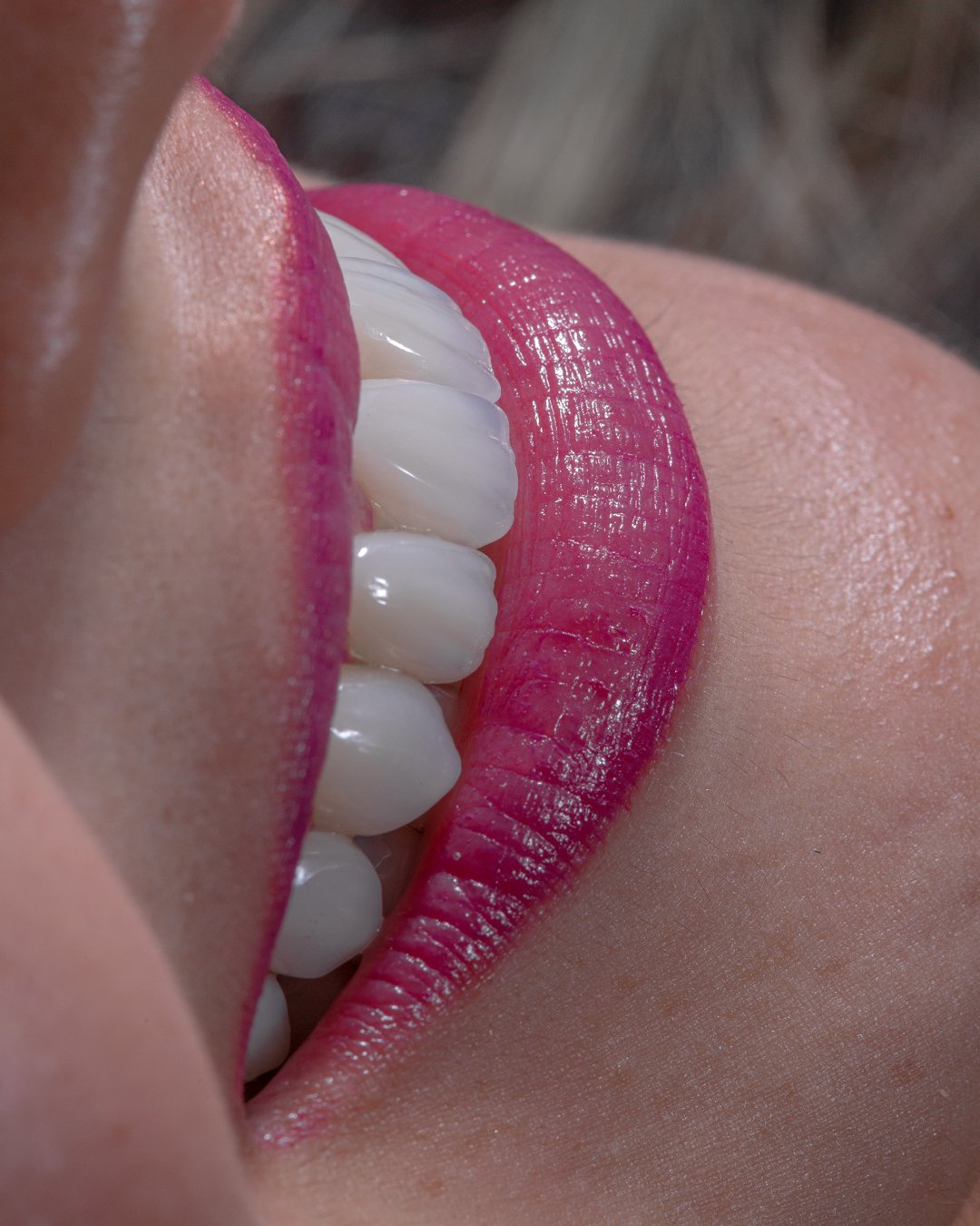 Mimetismo óptico excepcional en rehabilitación cerámica para una integración imperceptible.