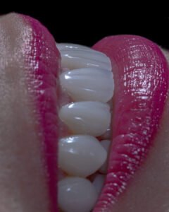 Resultado del protocolo de alta estética dental en 8 días para pacientes internacionales.