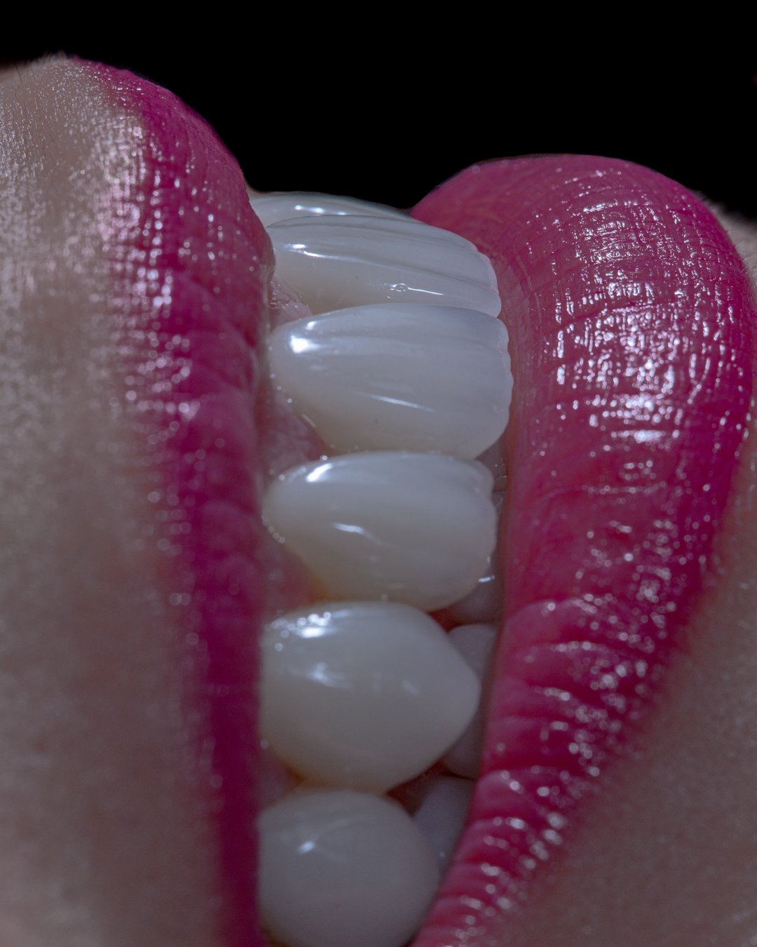 Resultado del protocolo de alta estética dental en 8 días para pacientes internacionales.