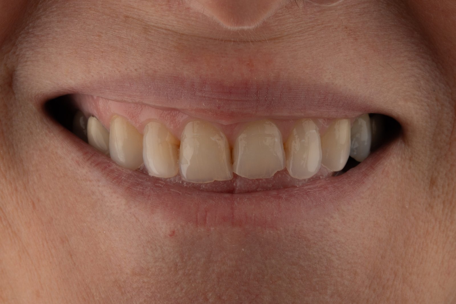 Diagnóstico de atrición dental severa y pérdida de dimensión vertical con colapso masticatorio en paciente femenina, tratado por la Dra. Lina Bedoya.