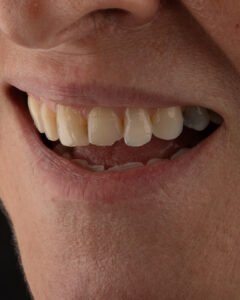 Evidencia de envejecimiento orofacial prematuro por colapso del plano oclusal y desgaste biomecánico.