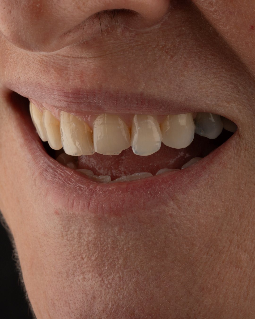 Evidencia de envejecimiento orofacial prematuro por colapso del plano oclusal y desgaste biomecánico.