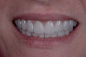 Sonrisa renovada con estética de autor en disilicato de litio estratificado a mano, logrando una armonía perfecta y naturalidad superior.