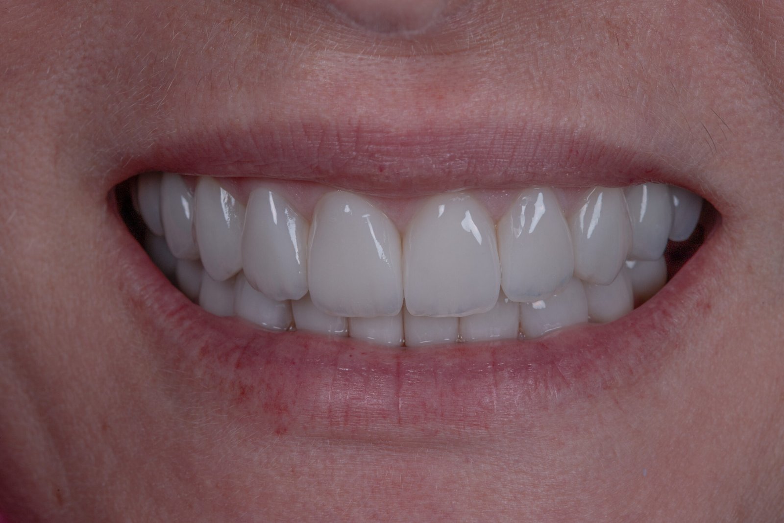 Sonrisa renovada con estética de autor en disilicato de litio estratificado a mano, logrando una armonía perfecta y naturalidad superior.