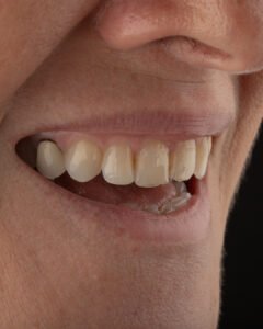 Registro fotográfico de la desarmonía facial resultante del déficit estructural en el tercio inferior del rostro.