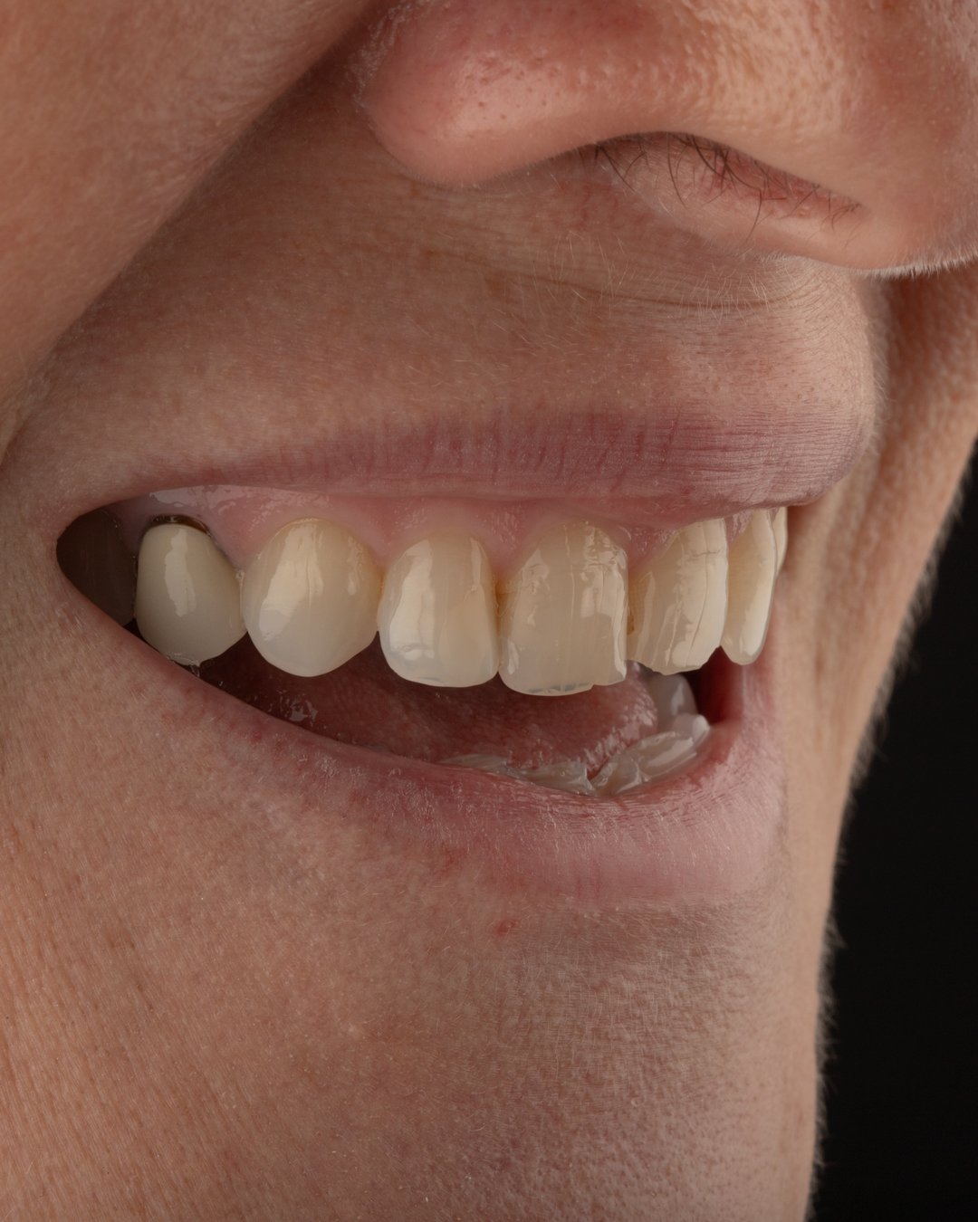 Registro fotográfico de la desarmonía facial resultante del déficit estructural en el tercio inferior del rostro.