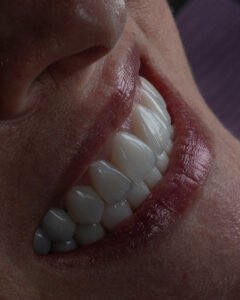 Rejuvenecimiento orofacial completo con levantamiento de mordida en disilicato de litio estratificado a mano.
