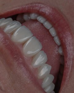 Rejuvenecimiento orofacial completo con levantamiento de mordida en disilicato de litio estratificado a mano.
