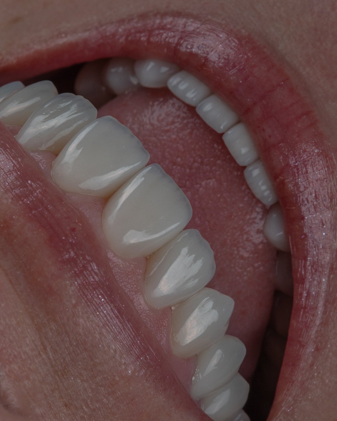 Rejuvenecimiento orofacial completo con levantamiento de mordida en disilicato de litio estratificado a mano.