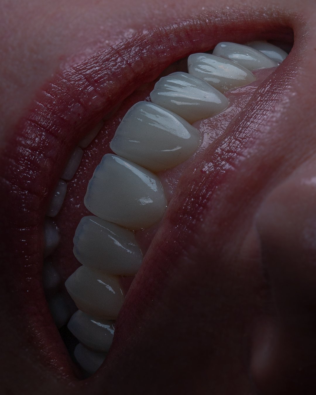 Recuperación de la armonía facial y soporte labial mediante arquitectura dental de alta gama por la Dra. Lina Bedoya.