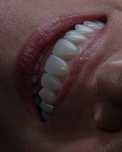 ntegración biológica perfecta y salud gingival en carillas de cerámica de autor con sellado periférico.