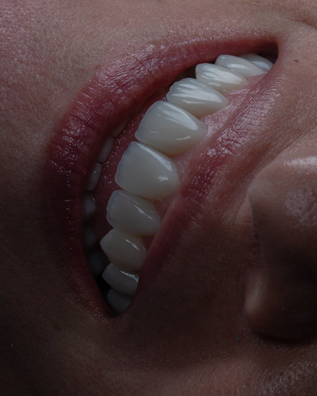 ntegración biológica perfecta y salud gingival en carillas de cerámica de autor con sellado periférico.