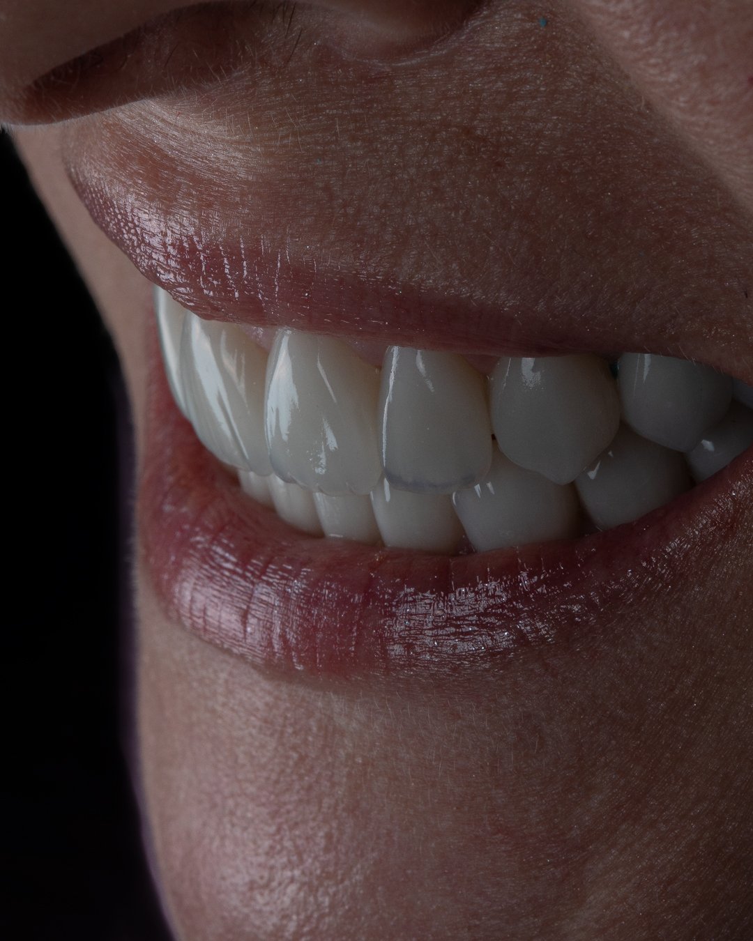 Detalle de mimetismo dental y translucidez incisal en carillas de disilicato de litio estratificadas a mano, logrando un reflejo de luz natural y rejuvenecimiento orofacial.
