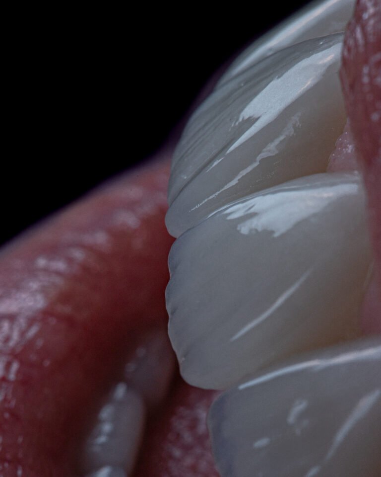 Proyección estética de la sonrisa con bordes translúcidos y opalescencia natural que imita el esmalte joven.