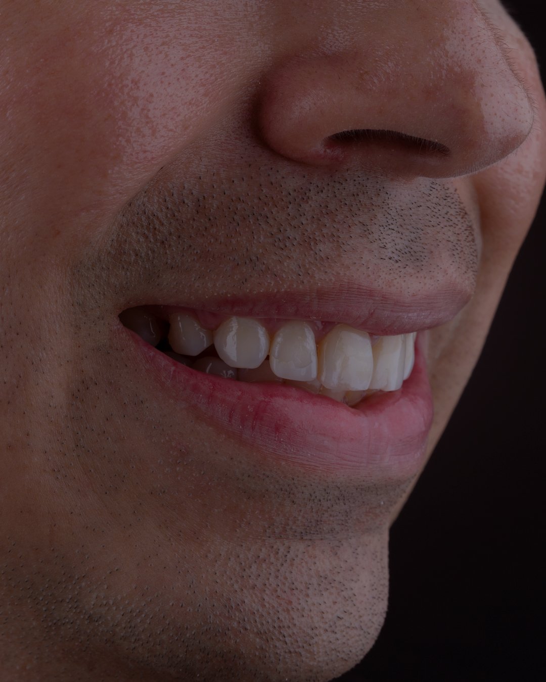 Estudio clínico lateral de un paciente masculino que presenta desadaptación y fatiga estructural en restauraciones de resina, documentado por la Dra. Lina Bedoya.