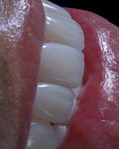 Estudio de microestética dental en carillas de disilicato de litio, resaltando la textura natural y la reflexión de luz lograda mediante estratificación artesanal por la Dra. Lina Bedoya.