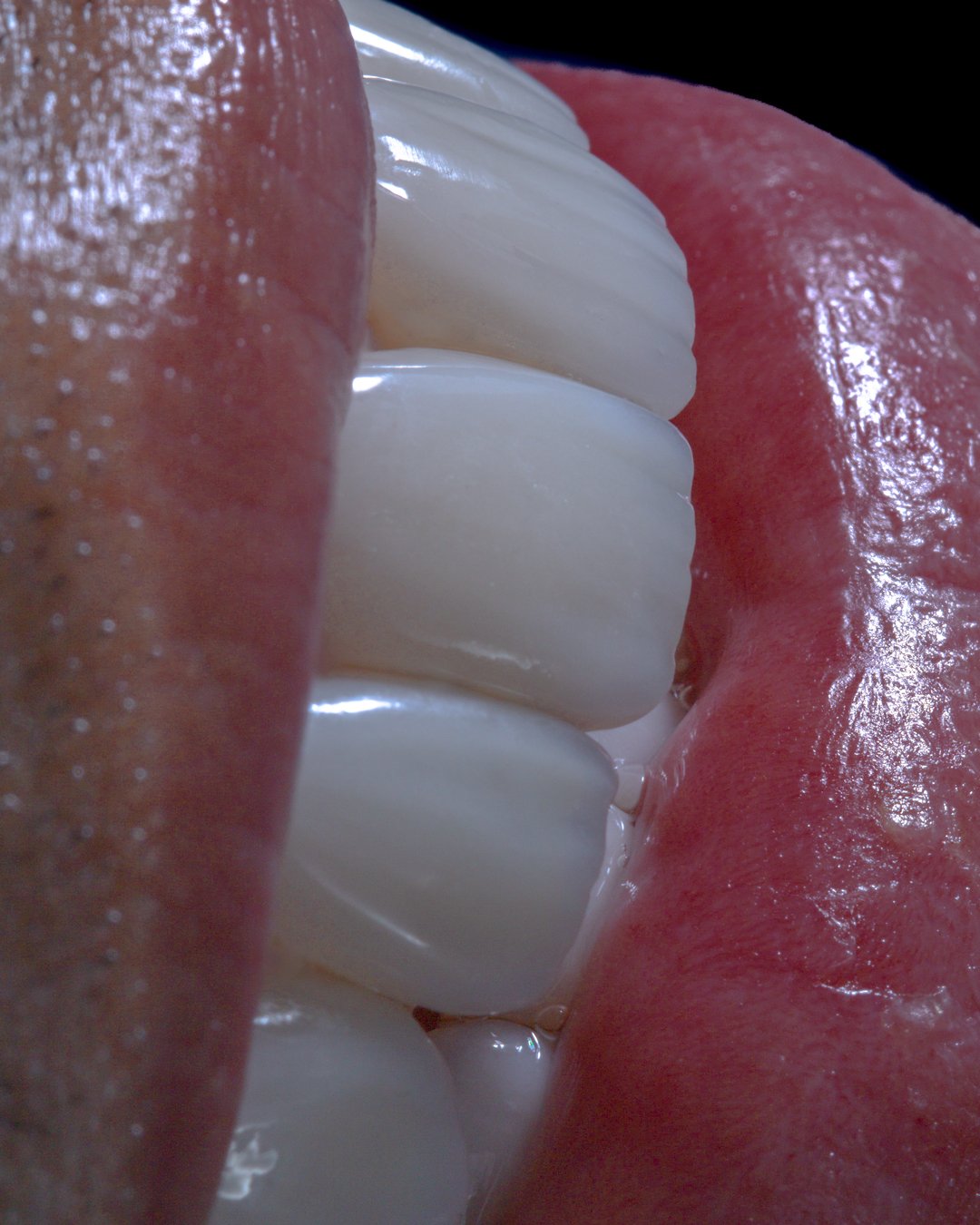 Estudio de microestética dental en carillas de disilicato de litio, resaltando la textura natural y la reflexión de luz lograda mediante estratificación artesanal por la Dra. Lina Bedoya.