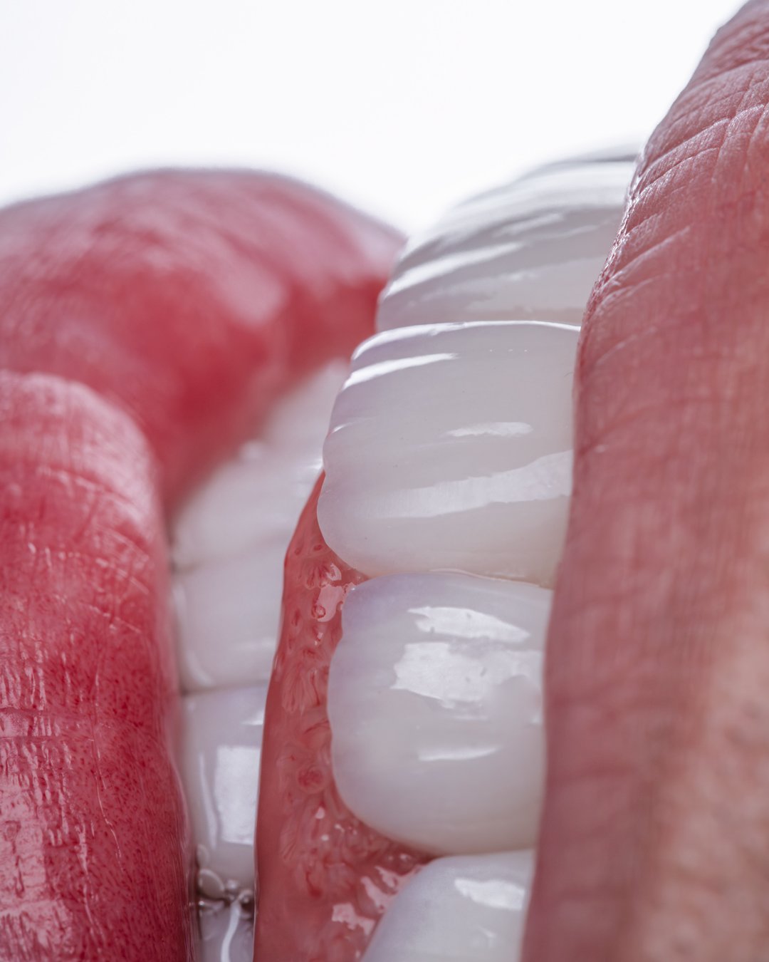 Resultado final de la rehabilitación oral masculina con carillas de disilicato de litio, logrando una sonrisa natural, armónica y de alta resistencia por la Dra. Lina Bedoya.