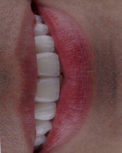 Perfección y equilibrio en una sonrisa masculina mediante el uso de disilicato de litio estratificado a mano, un diseño exclusivo de la Dra. Lina Bedoya.