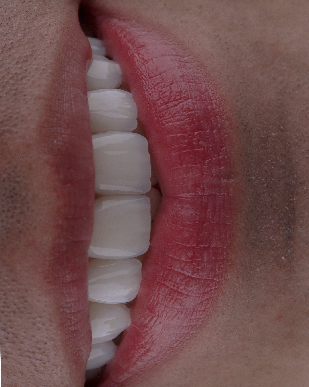 Perfección y equilibrio en una sonrisa masculina mediante el uso de disilicato de litio estratificado a mano, un diseño exclusivo de la Dra. Lina Bedoya.