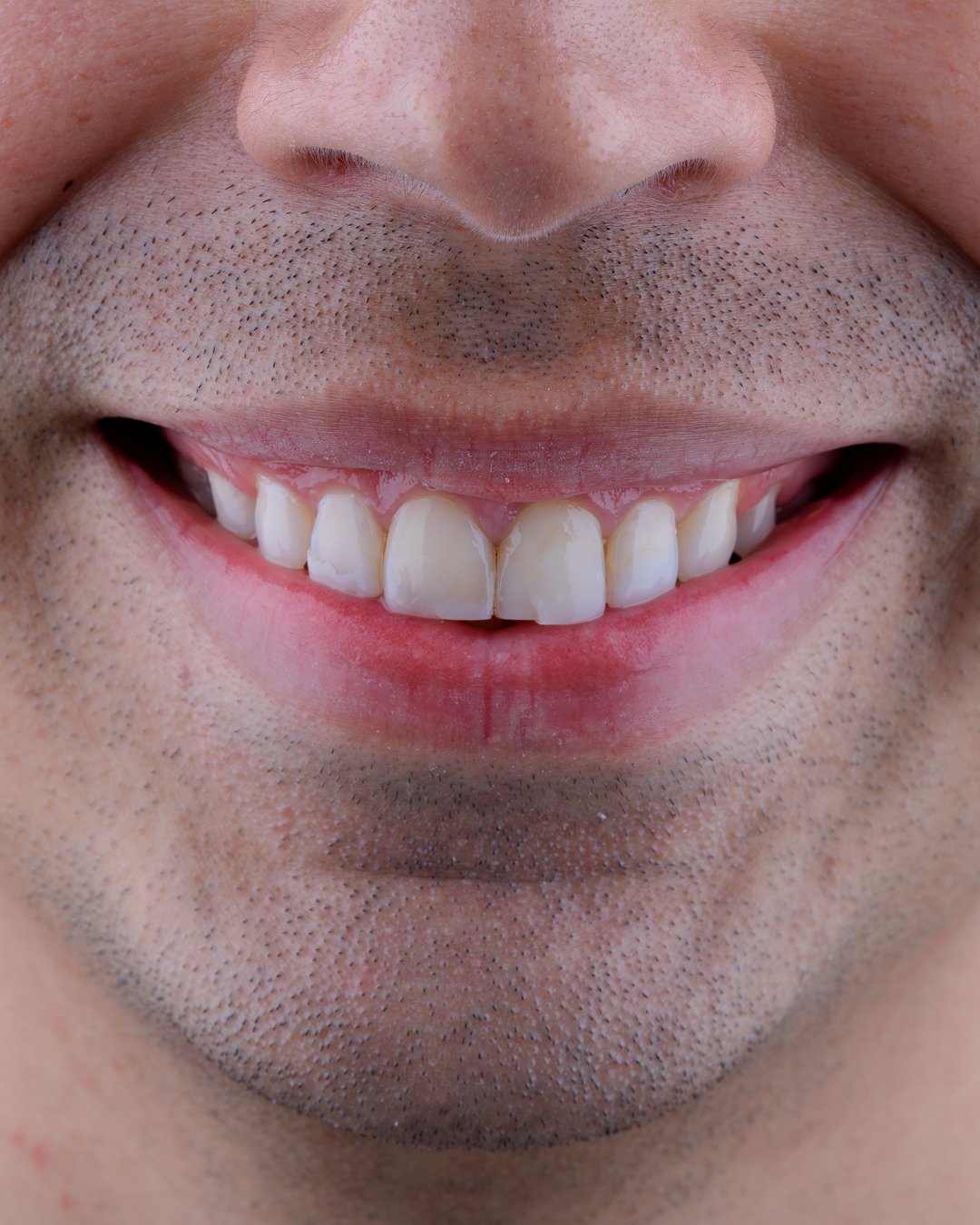 Análisis clínico de resinas convencionales con fatiga estructural y pérdida de mimetismo en paciente masculino, previo al protocolo cerámico de la Dra. Lina Bedoya.