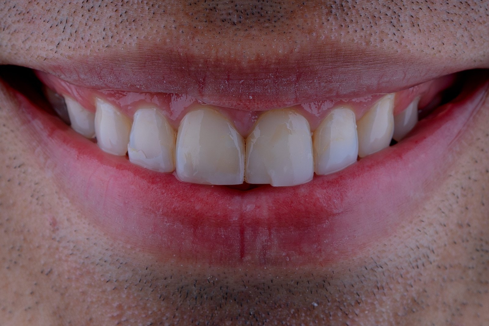 Sonrisa masculina con restauraciones en resina que presentan fatiga estructural y fracturas, evidenciando la necesidad de una rehabilitación definitiva