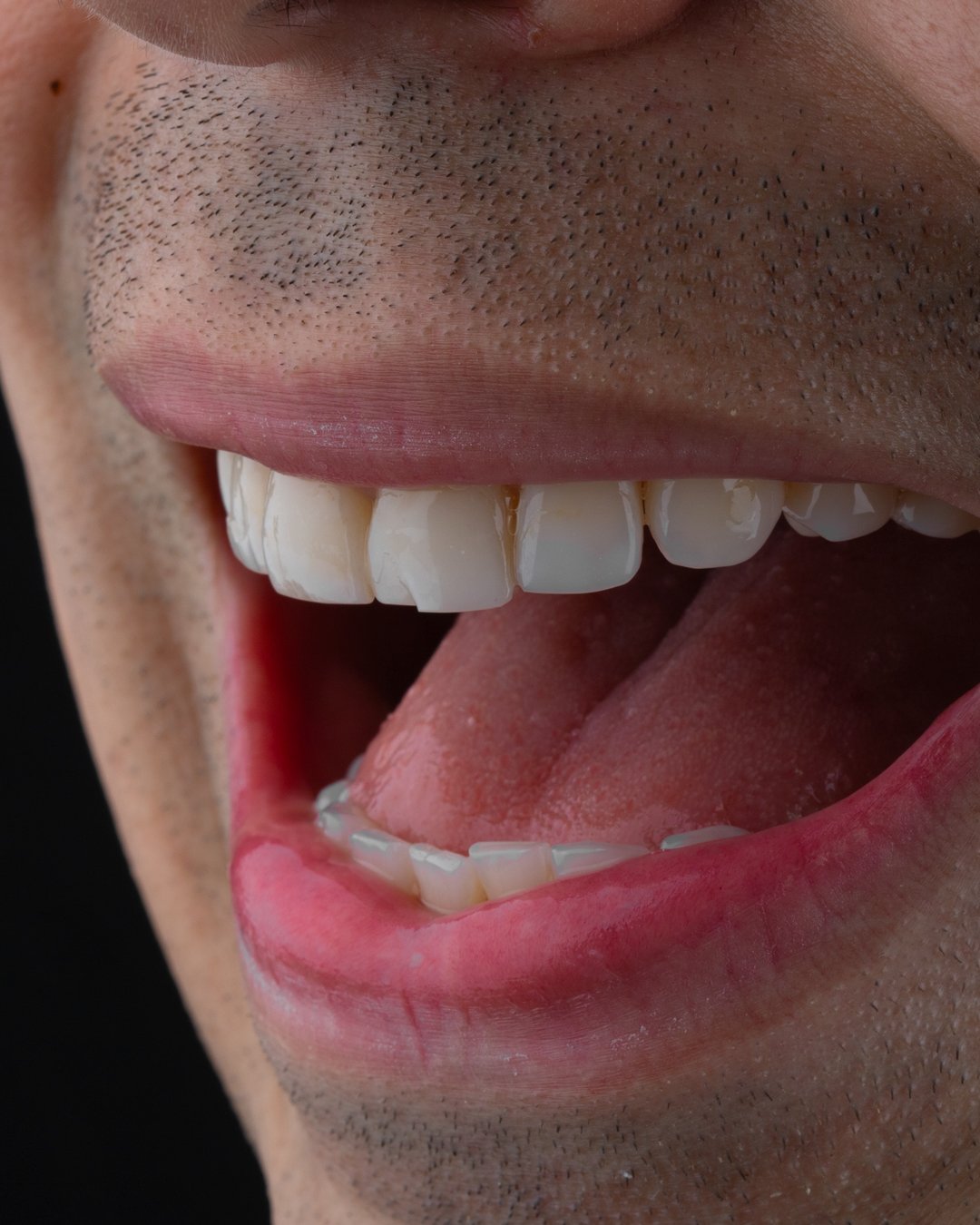 Fotografía clínica inicial que muestra el compromiso estético y estructural de restauraciones antiguas en resina, previo a su transformación