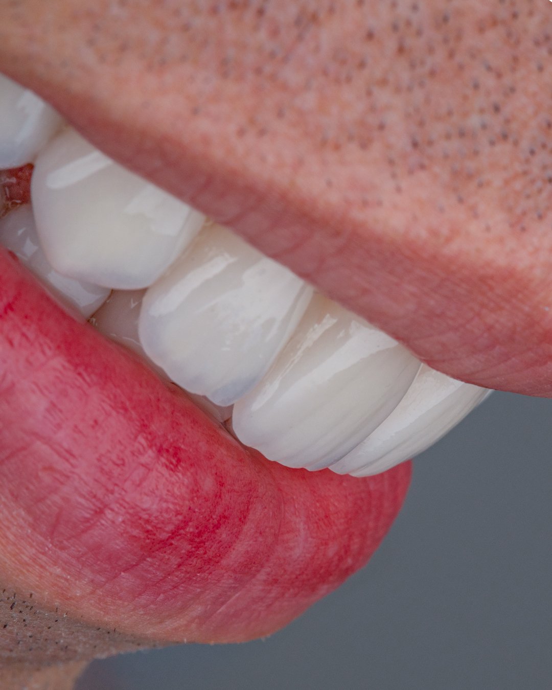 Detalle de perfil donde se aprecia la traslucidez y el mimetismo natural del disilicato de litio estratificado a mano por la Dra. Lina Bedoya.