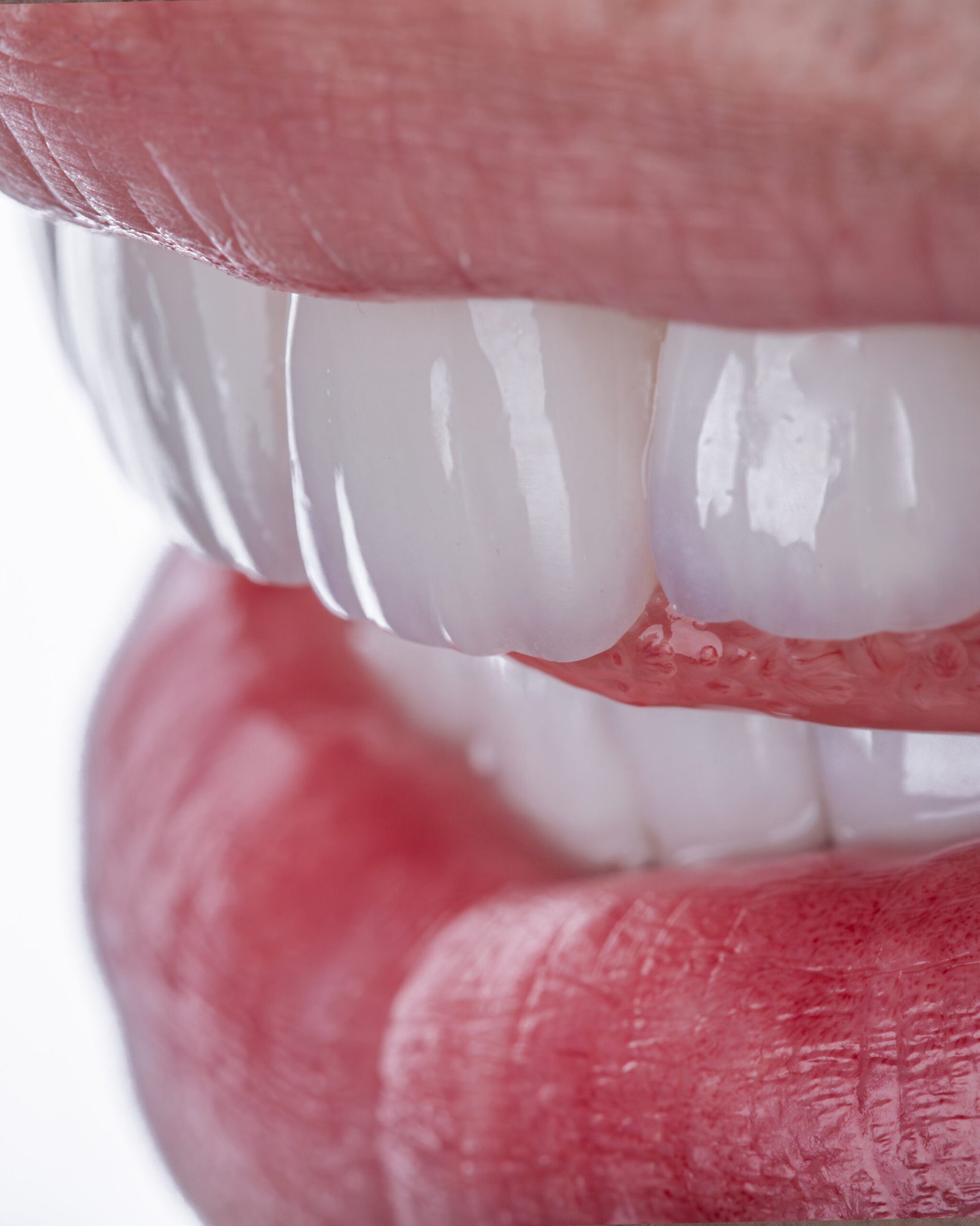 Vista frontal en primer plano de rehabilitación con carillas de disilicato de litio, destacando la microtextura, el valor cromático lograda por la Dra. Lina Bedoya.