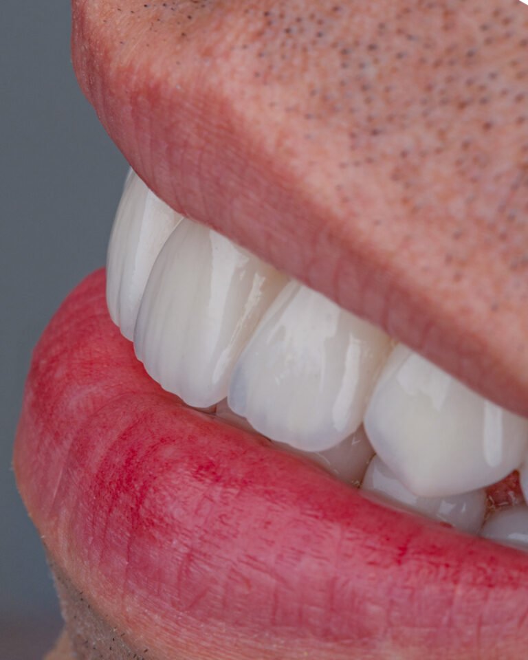 Detalle de perfil donde se aprecia la traslucidez y el mimetismo natural del disilicato de litio estratificado a mano por la Dra. Lina Bedoya.